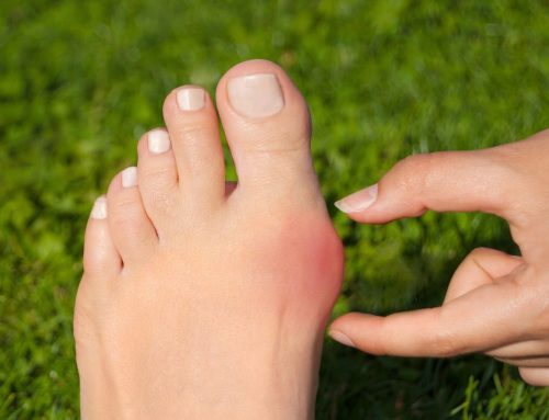 Hallux valgus: Ursachen, Symptome und Behandlung